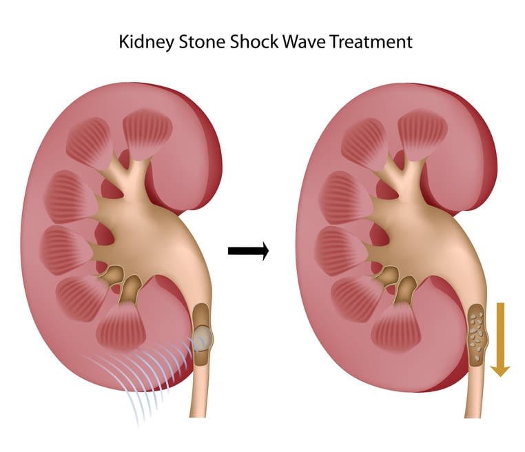 Kidney Stone Lithotripsy Northern Litho
